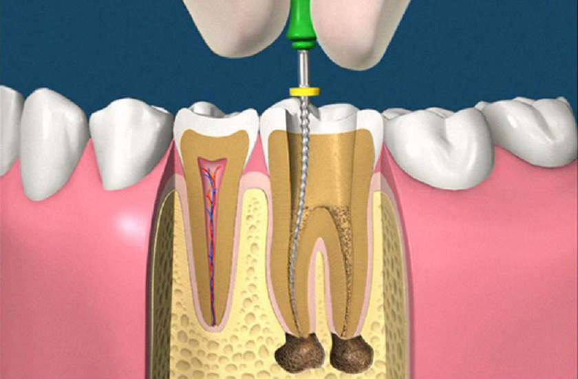 Cần điều trị tủy trước khi trám nếu tủy Tooth đã bị viêm nhiễm Cần điều trị tủy trước khi trám nếu tủy Tooth đã bị viêm nhiễm