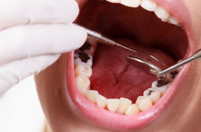 Thời gian trám Tooth còn tùy thuộc vào mức độ bệnh lý của Tooth Thời gian trám Tooth còn tùy thuộc vào mức độ bệnh lý của Tooth