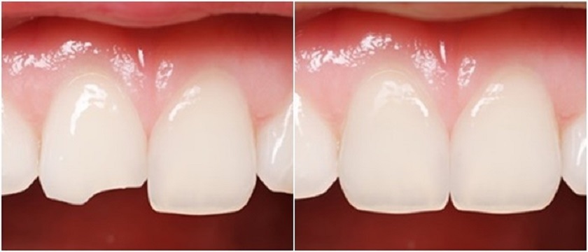 Trám Tooth phục Tooth bị sứt mẻ, gãy vỡ Trám Tooth phục Tooth bị sứt mẻ, gãy vỡ