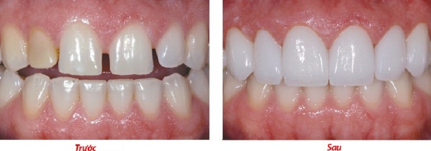 Trám Tooth cửa khắc phục tình trạng Tooth thưa hở kẽ Trám Tooth cửa khắc phục tình trạng Tooth thưa hở kẽ