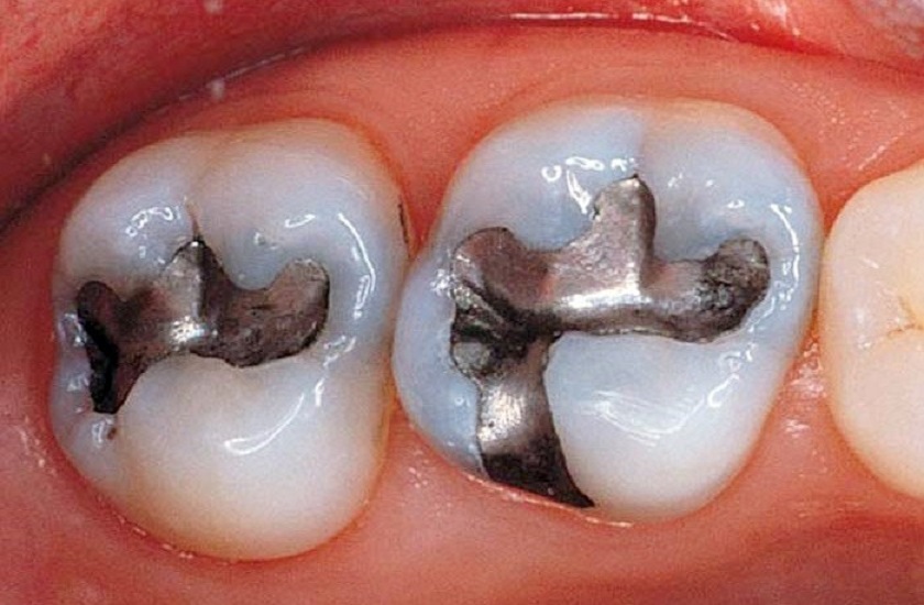 Sử dụng chất liệu Amalgam để trám Tooth Sử dụng chất liệu Amalgam để trám Tooth