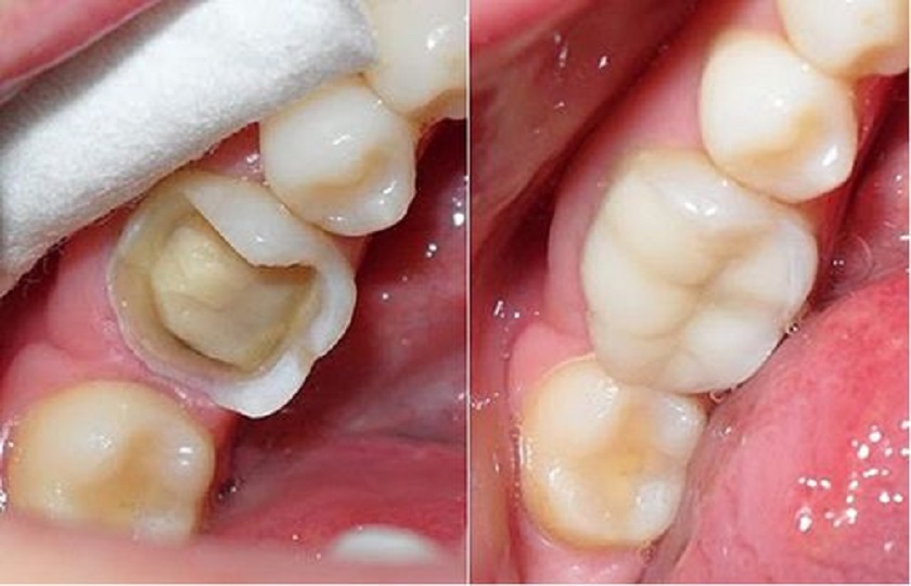 Trám Tooth bằng Composite là biện pháp được ứng dụng rất rộng rãi hiện nay Trám Tooth bằng Composite là biện pháp được ứng dụng rất rộng rãi hiện nay