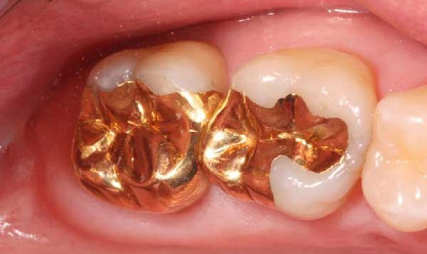 Trám Tooth bằng vàng Trám Tooth bằng vàng