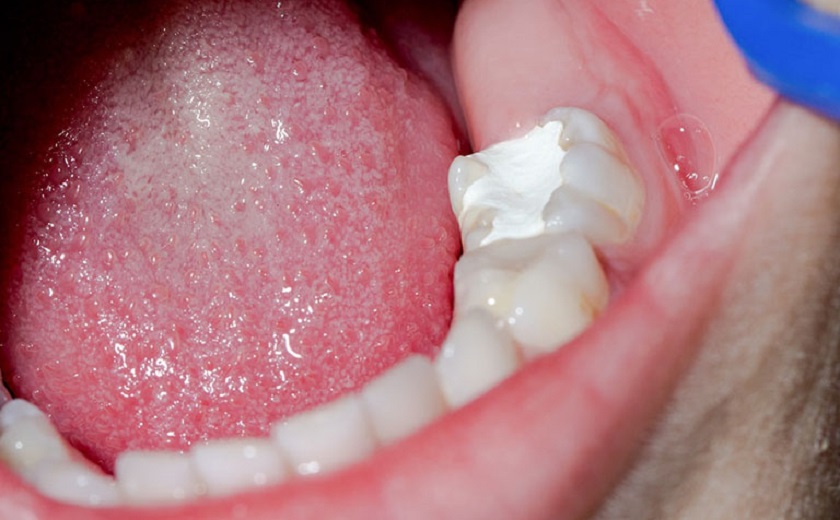 Trám Tooth bằng chất liệu GIC Trám Tooth bằng chất liệu GIC