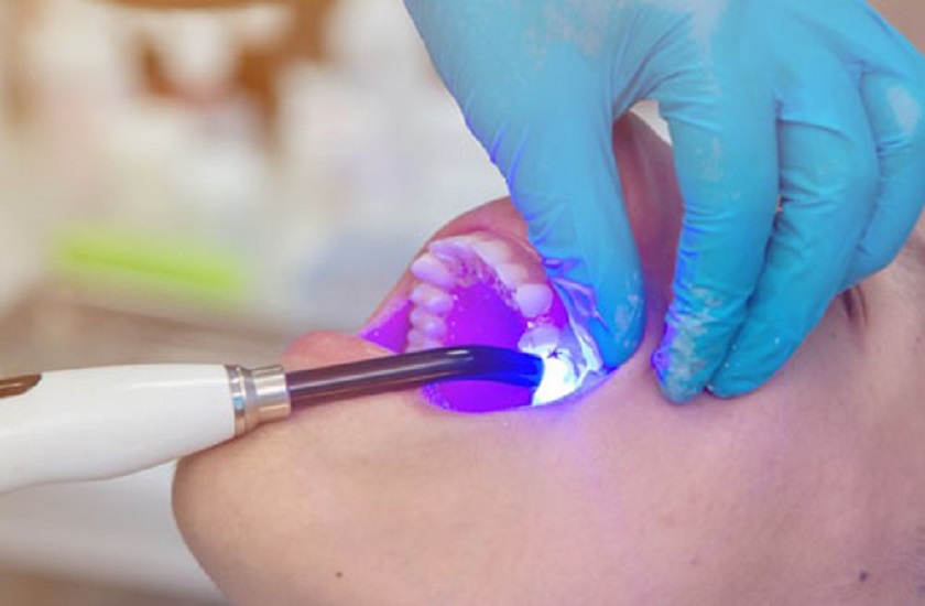 Trám bít Tooth và làm đông vật liệu trám bằng đèn chiếu Laser Trám bít Tooth và làm đông vật liệu trám bằng đèn chiếu Laser